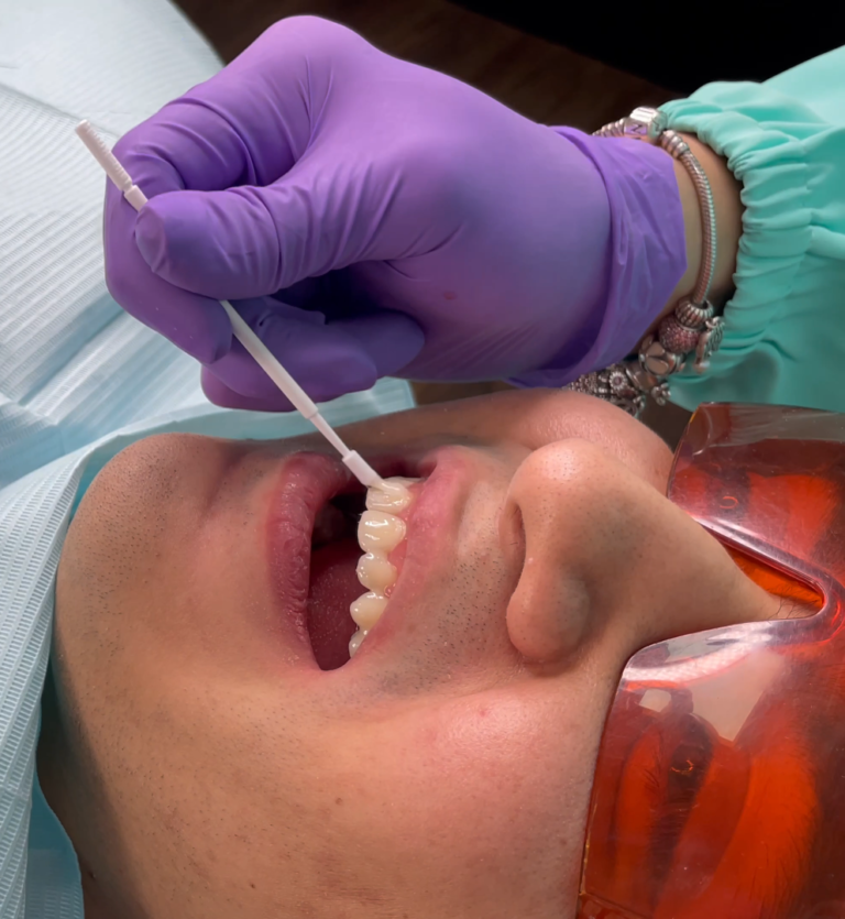 Dra. Natalia Morales aplicando un barniz dental a un paciente para evitar sensibilidad