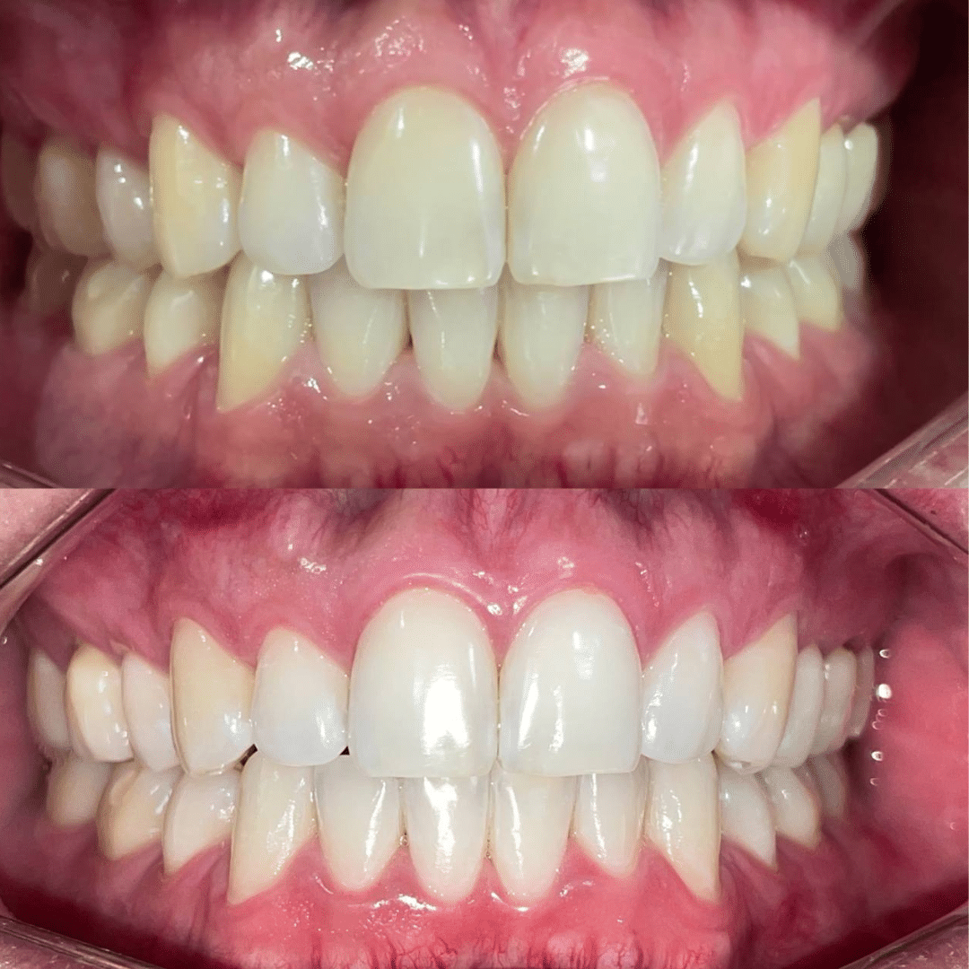 Resultado de blanqueamiento dental - Antes y después