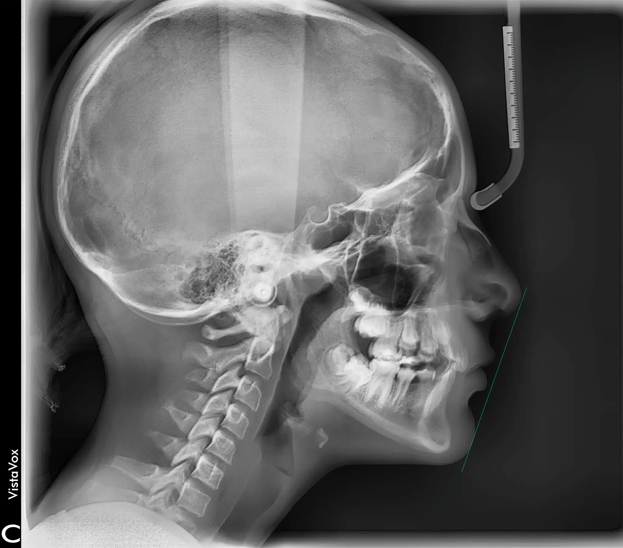 Radiografía lateral de cráneo para planificar un tratamiento de ortodoncia