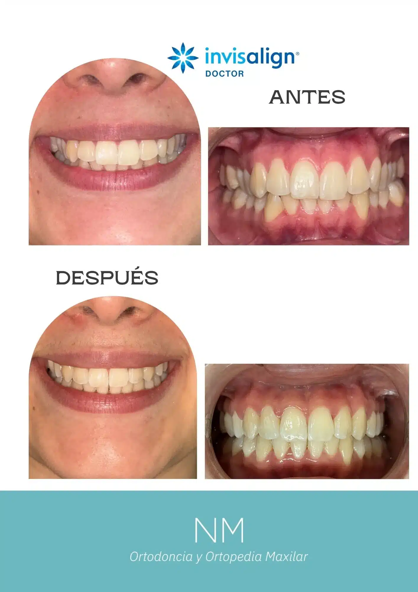 Antes y después de un tratamiento de ortodoncia invisible con Invisalign