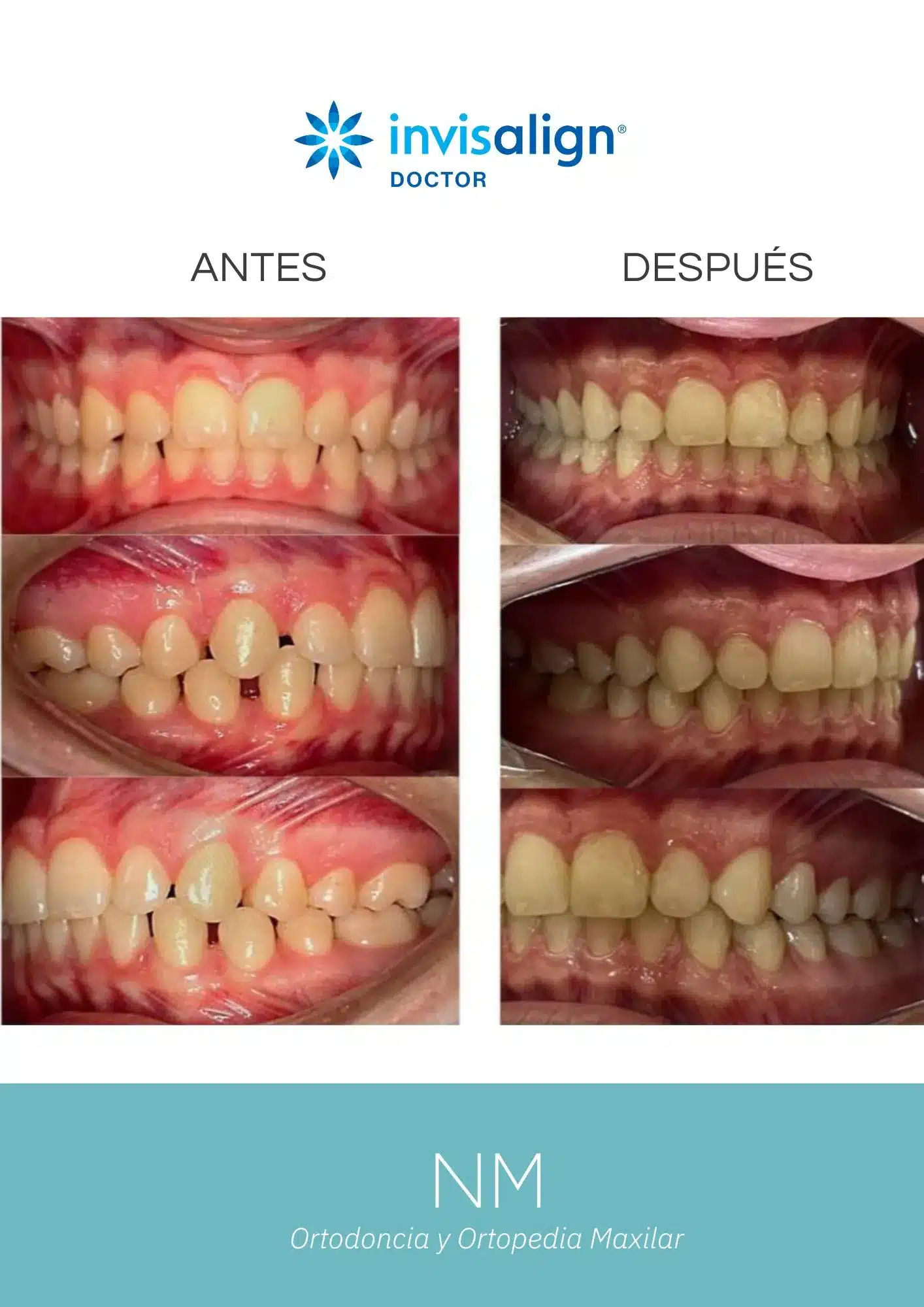Resultado de un tratamiento de ortodoncia con alineadores Invisalign