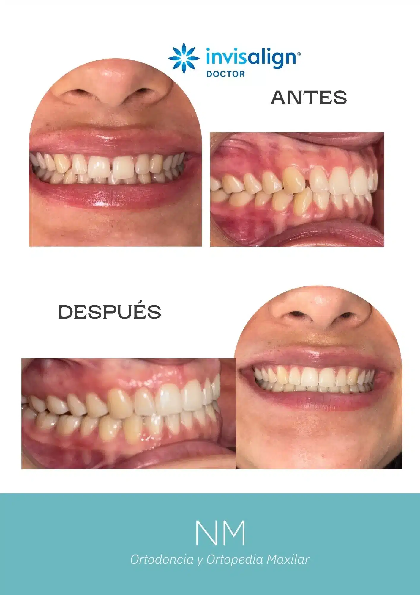 Sonrisa antes y después de ortodoncia con alineadores invisibles