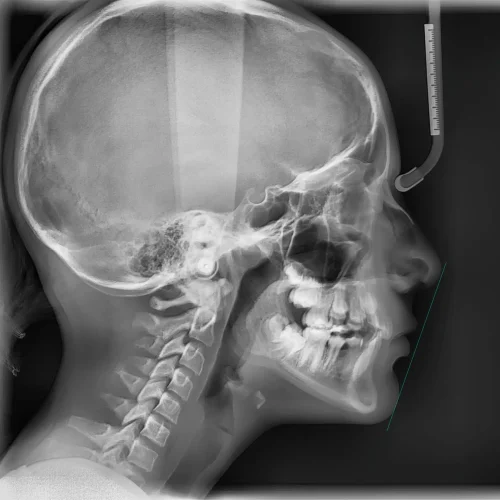 Lateral de cráneo de paciente de la Dra. Natalia Morales